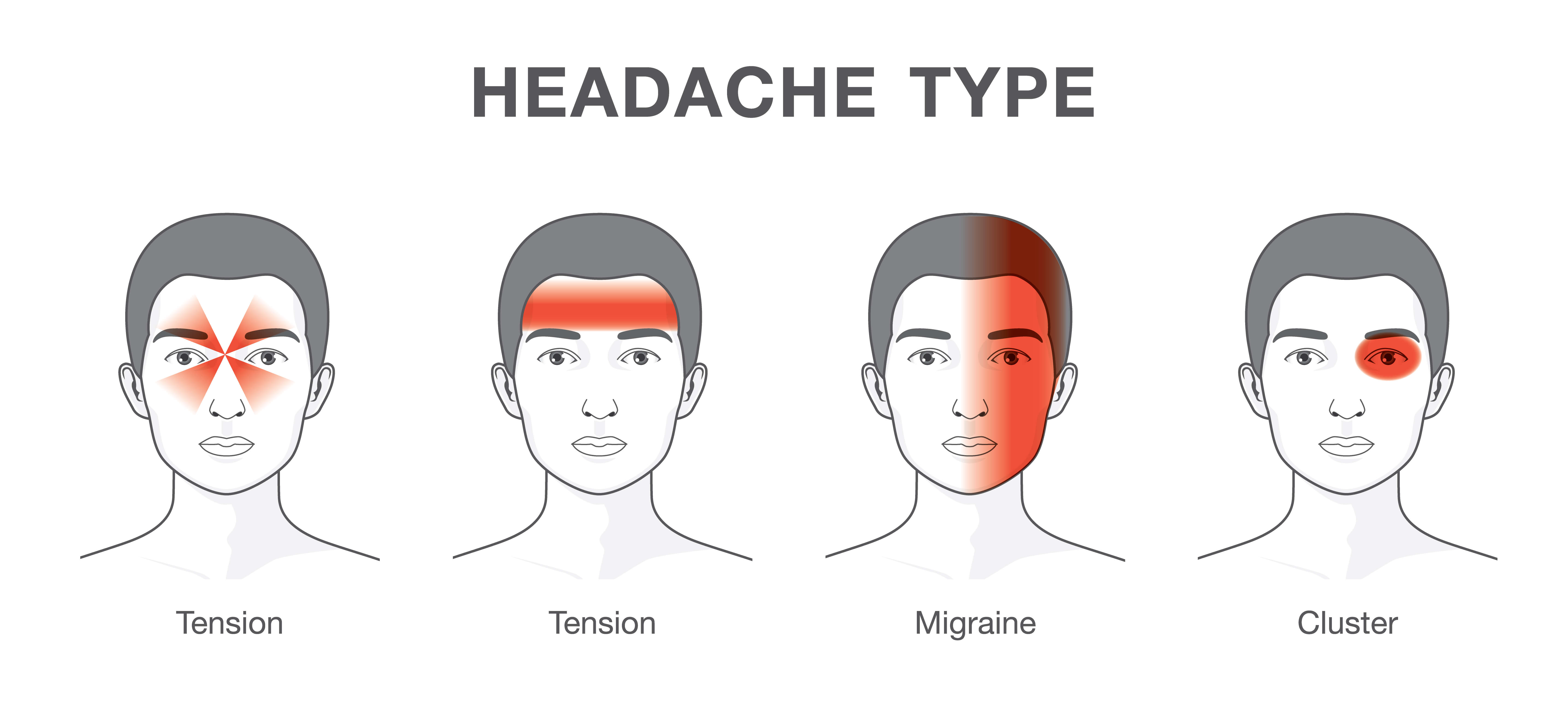 The Different Types Of Headaches Scoopify